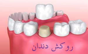 عصب کشی دندان در کرج