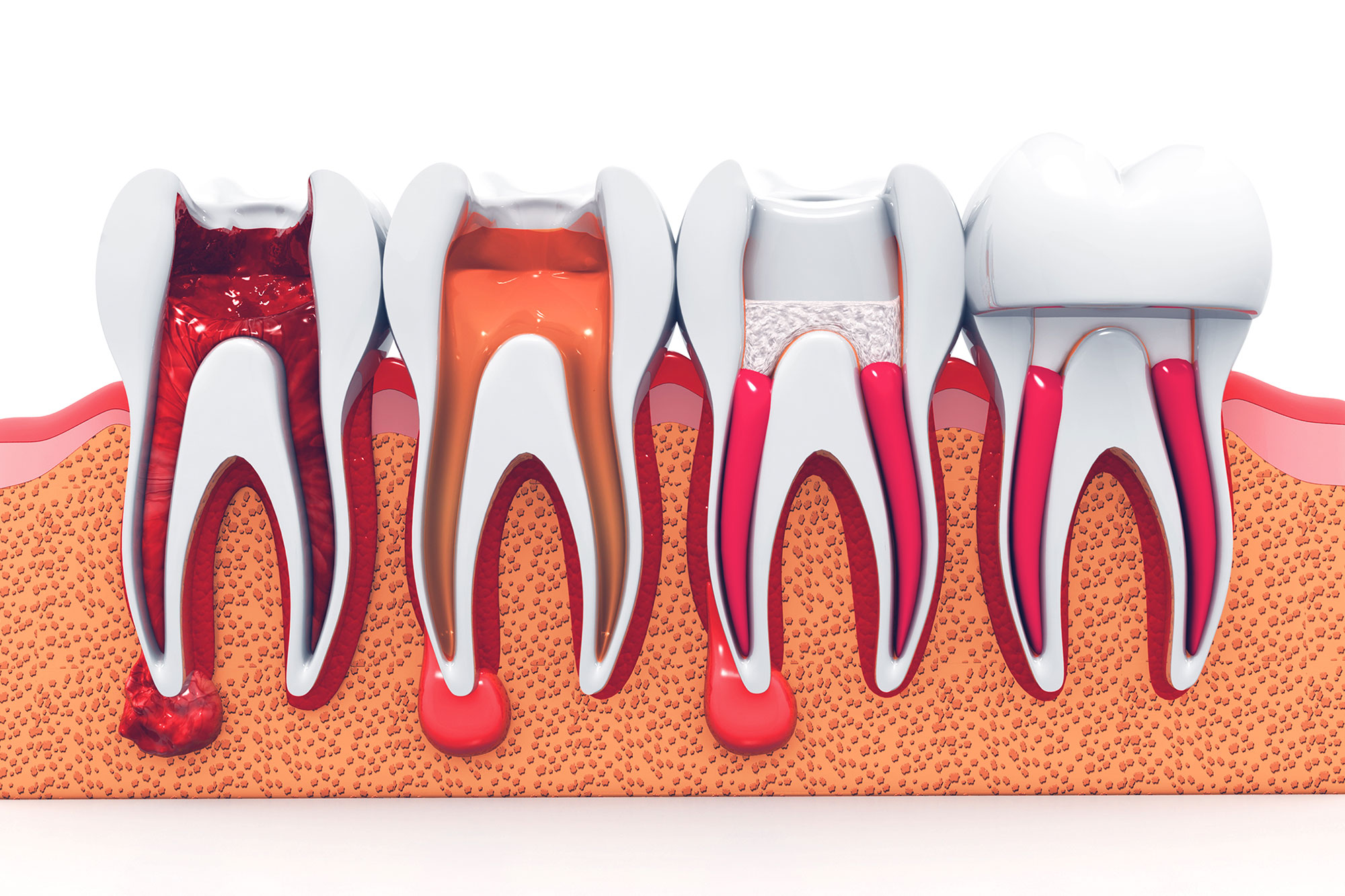 قیمت عصب کشی دندان در کرج