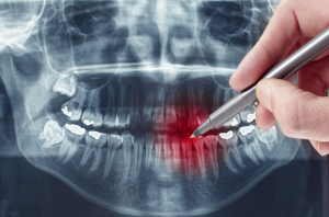 روکش دندان عصب کشی شده در کرج