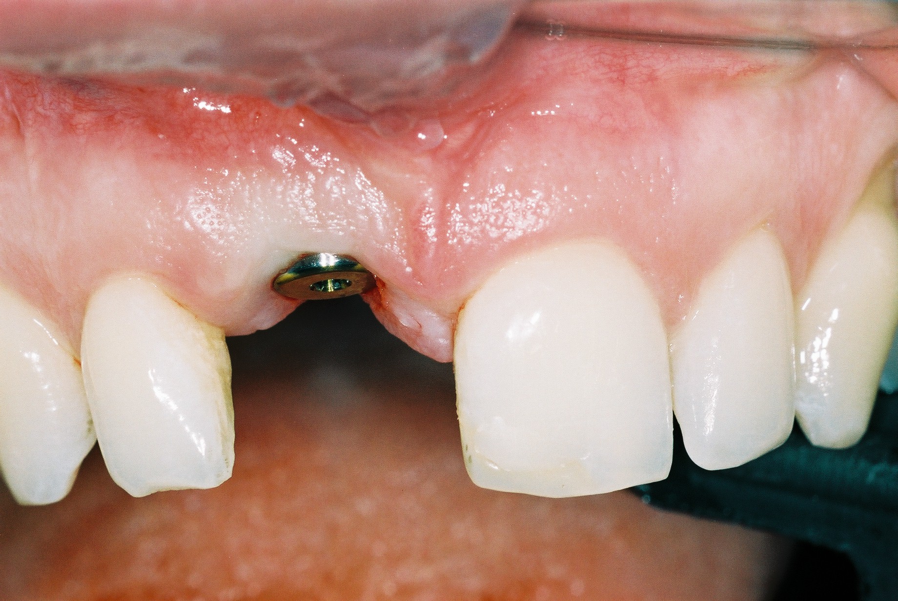 ایمپلنت دندان جلو در کرج